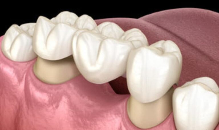 A Complete Guide To Dental Crown & Bridge