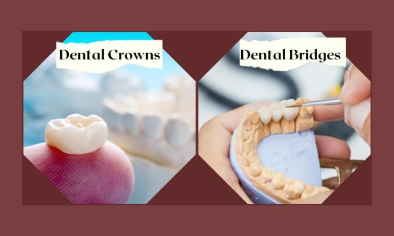 Difference Between Dental Crowns & Bridges