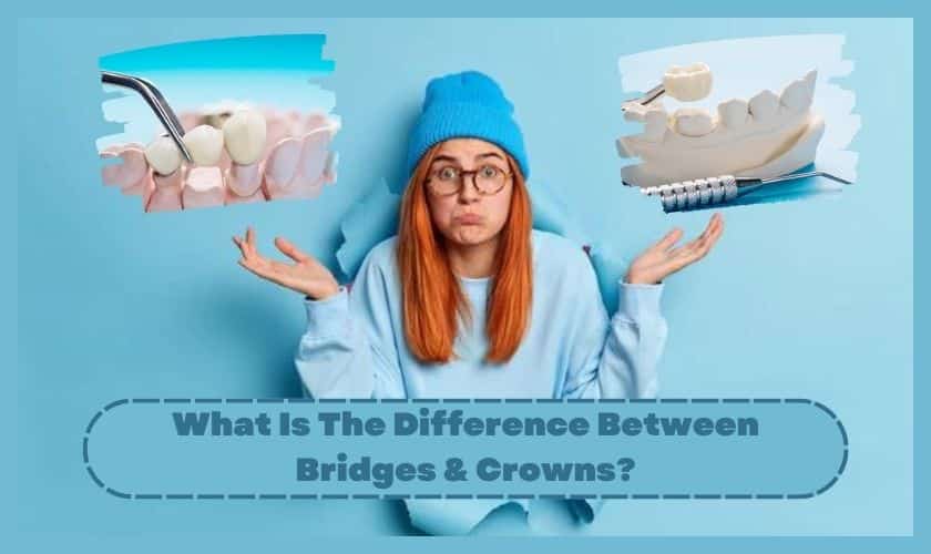 Difference Between Bridges Crowns 1