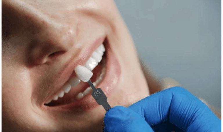 What Are Dental Veneers And What Dental Problems Can They Fix?