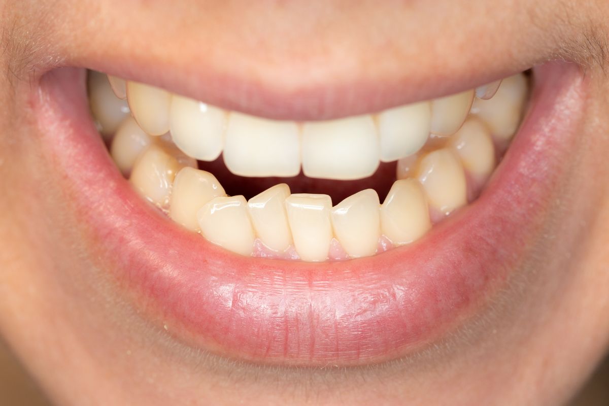 Causes of crowded teeth and treatment options for teeth alignment
